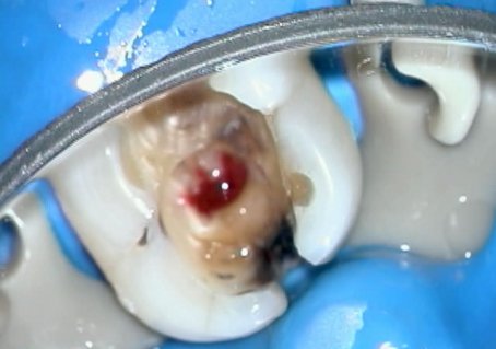 Глубокий кариес зуб 4.6 лечение под микроскопом