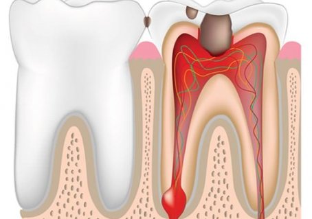 Строение зуба, кариес и его осложненные формы
