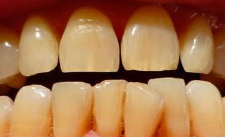 Методы лечения трещин на зубах
