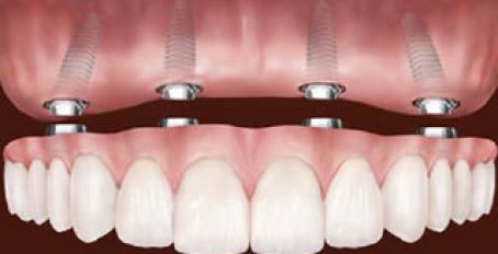 Протезирование зубов: современные методы и инновации