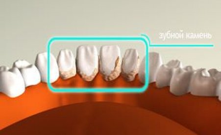 Как избавиться от зубного камня в домашних условиях