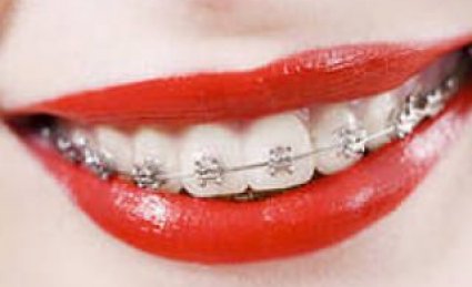 Отбеливание зубов и лечение брекетами….польза или вред?!