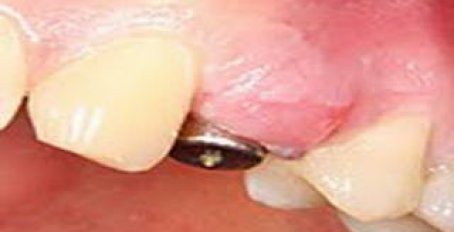 Какие бывают осложнения после имплантации зубов