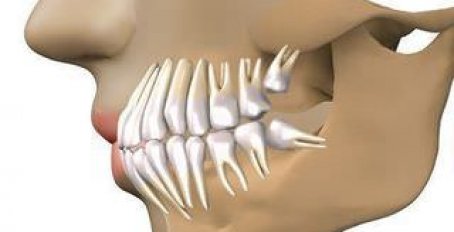 Как удаляют зуб мудрости на верхней челюсти