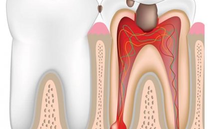 Строение зуба, кариес и его осложненные формы