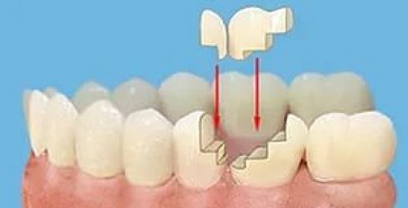 Что такое вкладка в стоматологии