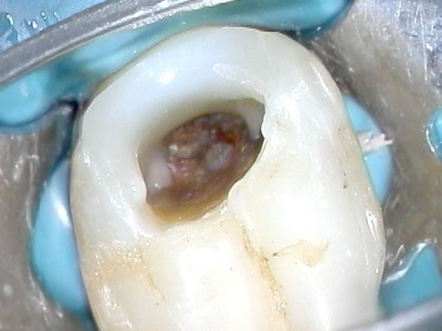 Пульпит зуба