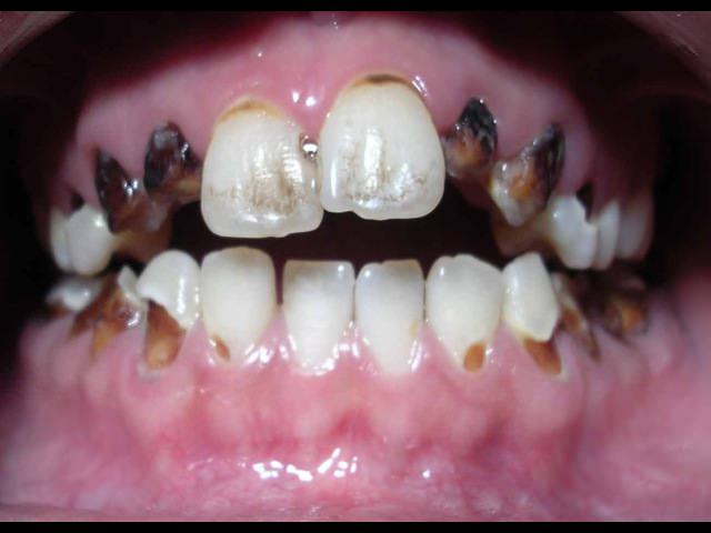 Гнилые зубы