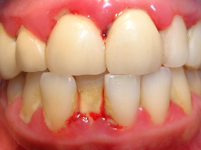 Больные зубы
