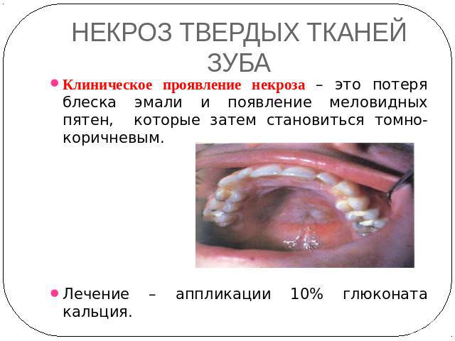 Гипоплазия эмали фото у детей