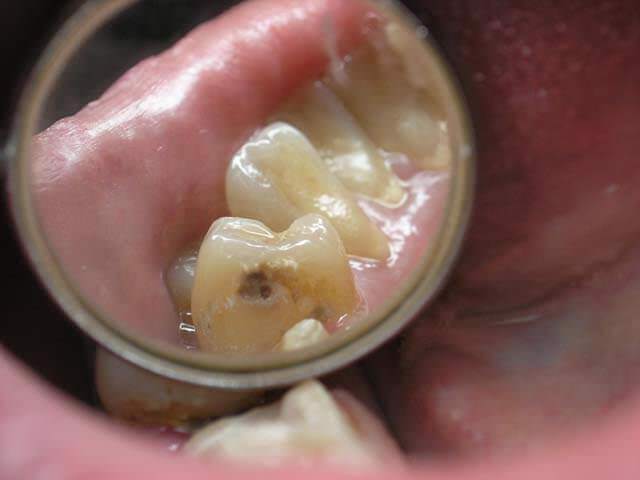 Кариес является относительным противопоказанием к проведению имплантации зубов