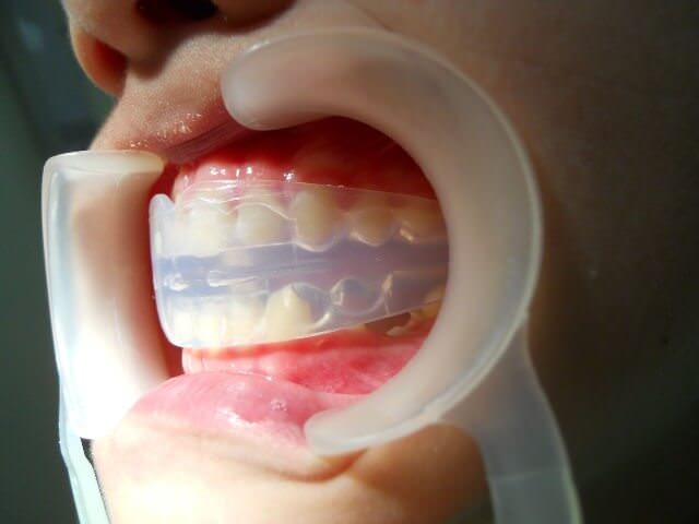 Трейнеры являются средством выравнивания зубов, особенного детских