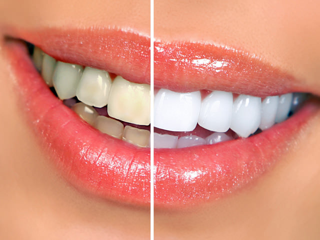 Способы отбеливания зубов