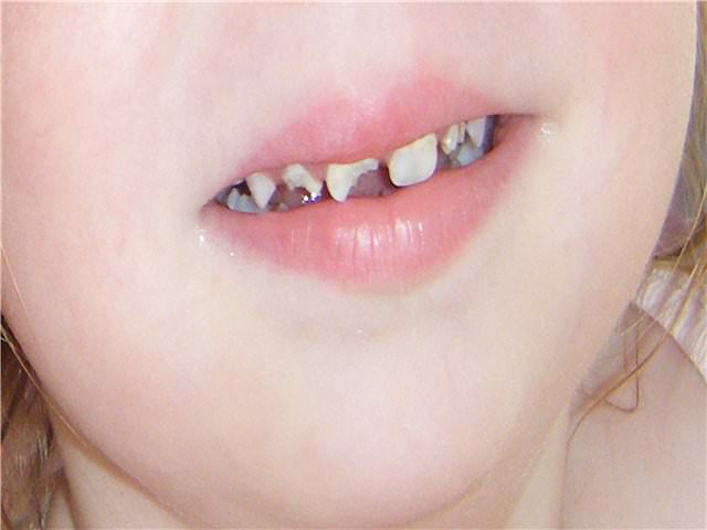 Испорченные зубы 