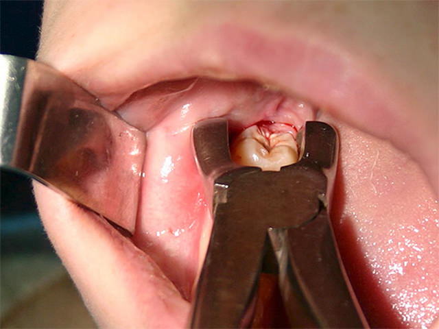 Операция по удалению зубов