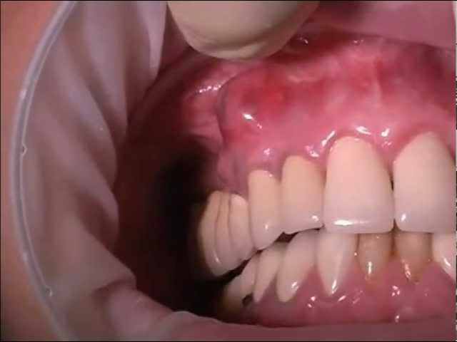 Всегда есть определенный зуб, который вызвал воспаление ткани