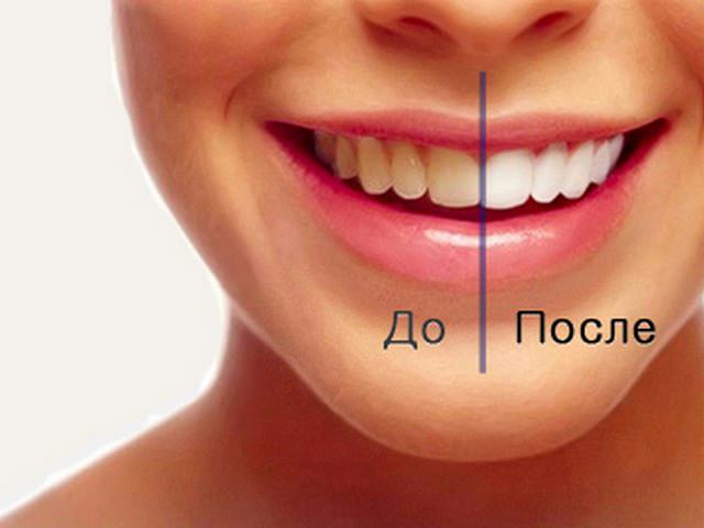 Пожелтение зубов может происходить из-за неправильной гигиены полости рта