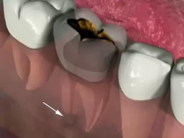 При перидонтите могут болеть все зубы thumbnail