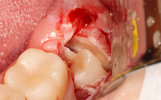 Полоскание после удаления зуба