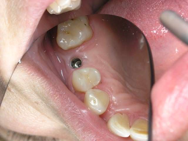 Один из промежуточных этапов протезирования зубов