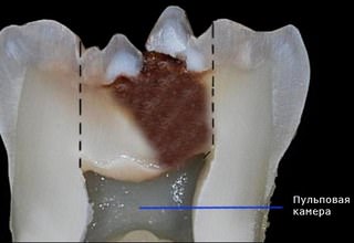 Пульпит зуба у взрослых — симптомы и виды