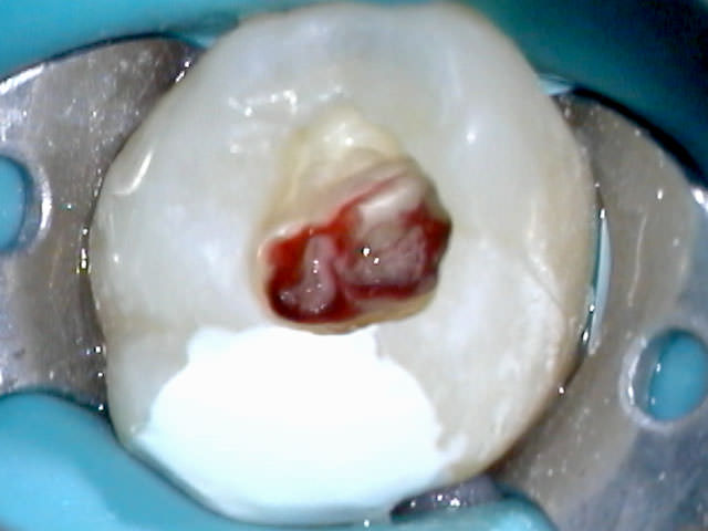 Пульпит в зубе