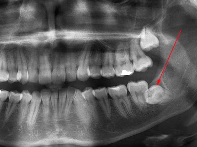 Ретинированный зуб мудрости на рентгеновском снимке