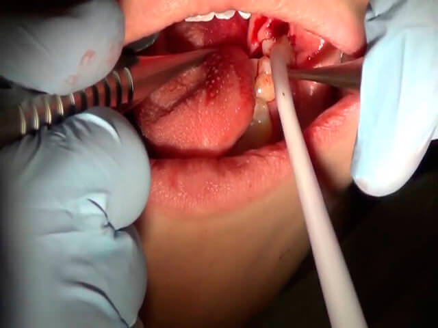 Изображена операция удаления ретинированного зуба