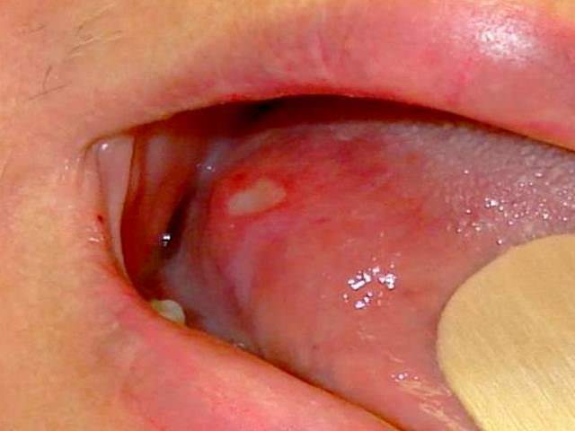 Стоматит на поверхности языка