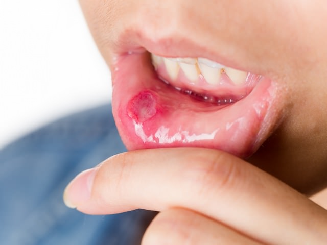 Стоматит на внутренней части губ человека