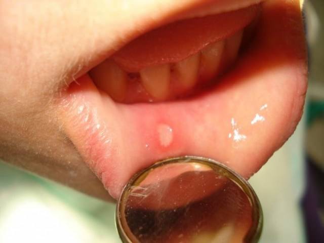 Стоматит на внутренней стороне губ