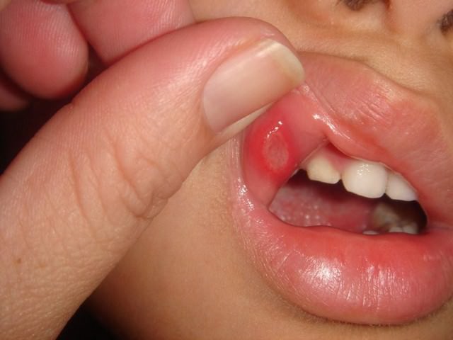 Стоматит на внутренней части верхней губы человека