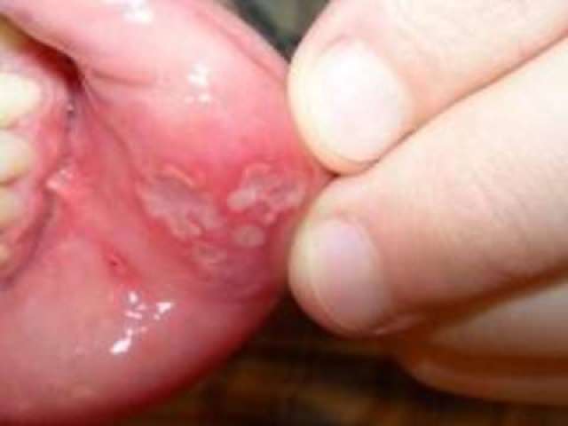 На внутренней стороне губ человека мы можем увидеть стоматит