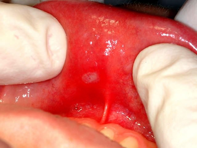 Стоматит расположенный на внутренней части губ человека