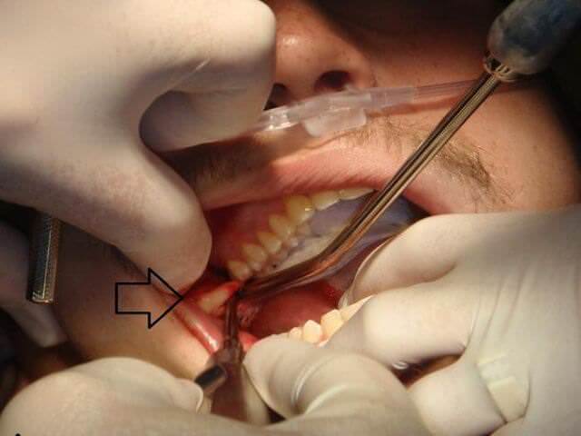 Зуб восьмерка верхний лечение thumbnail