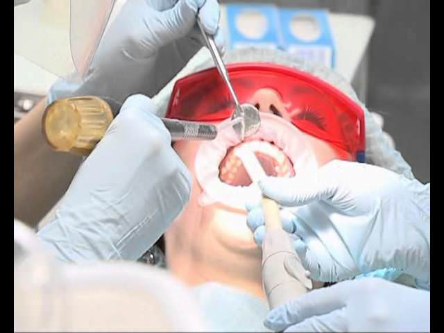 Ультразвуковая чистка зубов противопоказания беременность thumbnail