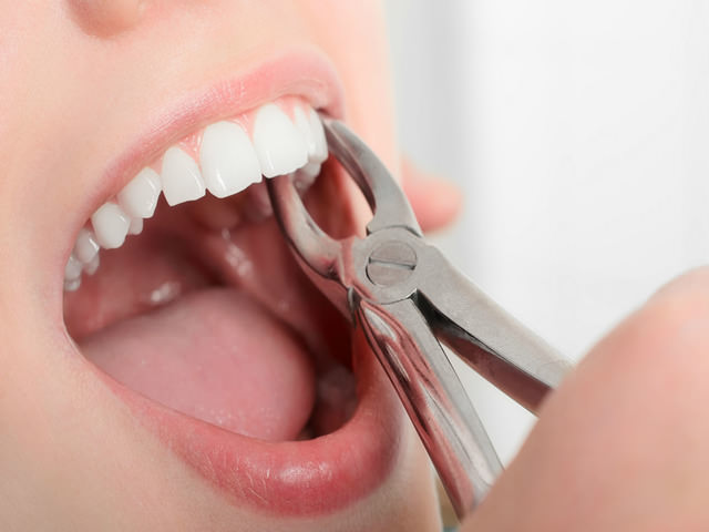 Стоматолог удаляет зуб
