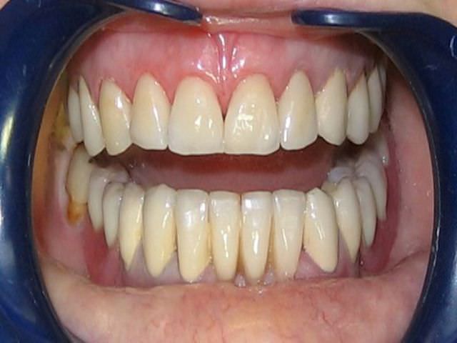 Из чего делают зубные протезы материалы
