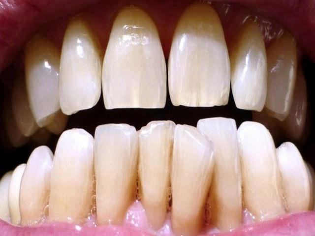 Трещины эмали зубов лечение в домашних условиях thumbnail