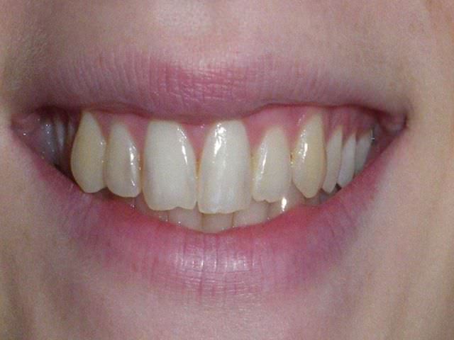 Микротрещины на зубах лечение в домашних thumbnail