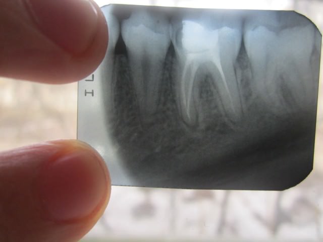 Рентген зуба